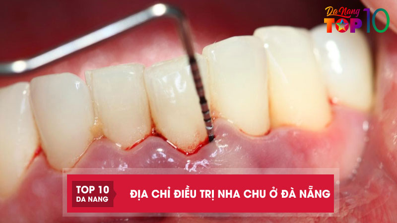 Top 10 địa chỉ điều trị nha chu ở Đà Nẵng uy tín, bác sĩ giỏi