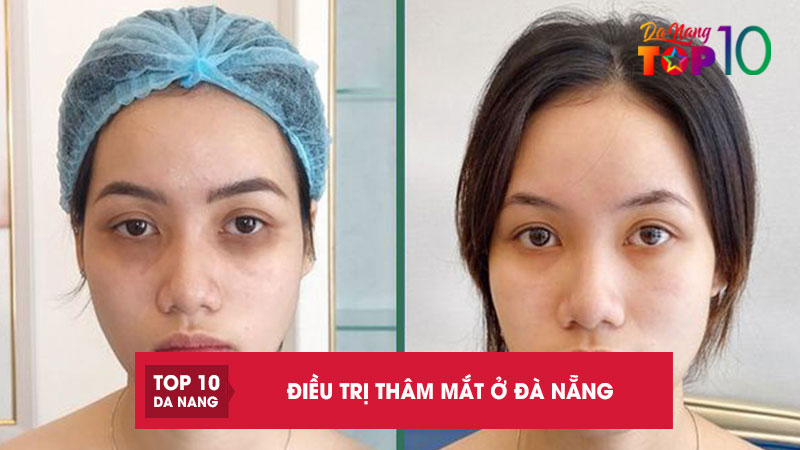 Top 10 điều trị thâm mắt ở Đà Nẵng hiệu quả sau 1 liệu trình