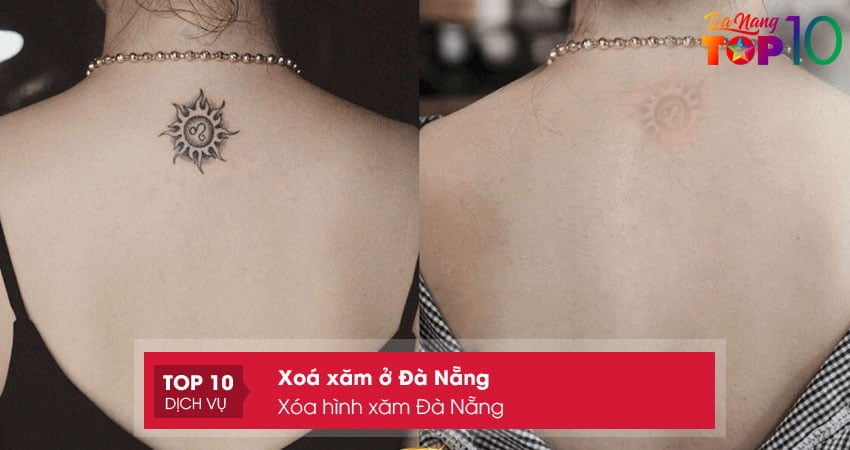 xoa-hinh-xam-da-nang-top10danang